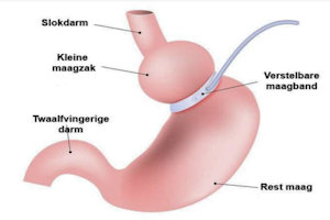 Virtuele maagband: een veilig alternatief voor chirurgische ingrepen
